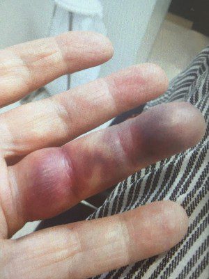 Numb & Painful Fingers in Winter? It Could Be Raynaud's Disease